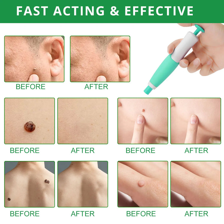 Auto Skin Tag Removal Kit 2-8mm Body Facial Beauty Tool