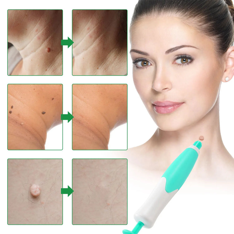 Auto Skin Tag Removal Kit 2-8mm Body Facial Beauty Tool